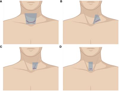 Comparisons of different approaches and incisions of thyroid surgery and selection strategy